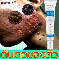 【เห็นผลได้ชัดเจน】 BEOTUA ครีมกำจัดสิว ลดสิวถาวร 50g ซ่อมแซมรอยสิว ลบสิวโดยไม่ทิ้งรอย(เจลแต้มสิว เจลรักษาสิว ครีมลดรอยสิว ครีมรักษาสิว ครีมลดสิวถาวร รักษาสิวอุดตัน เเก้สิว ครีมแต้มสิวยุบ หลุมสิว ยาแต้วสิว สิวหายเร่งด่วน ลดสิวเร่งด่วน ยาแก้สิว กำจัดสิวถาวร）