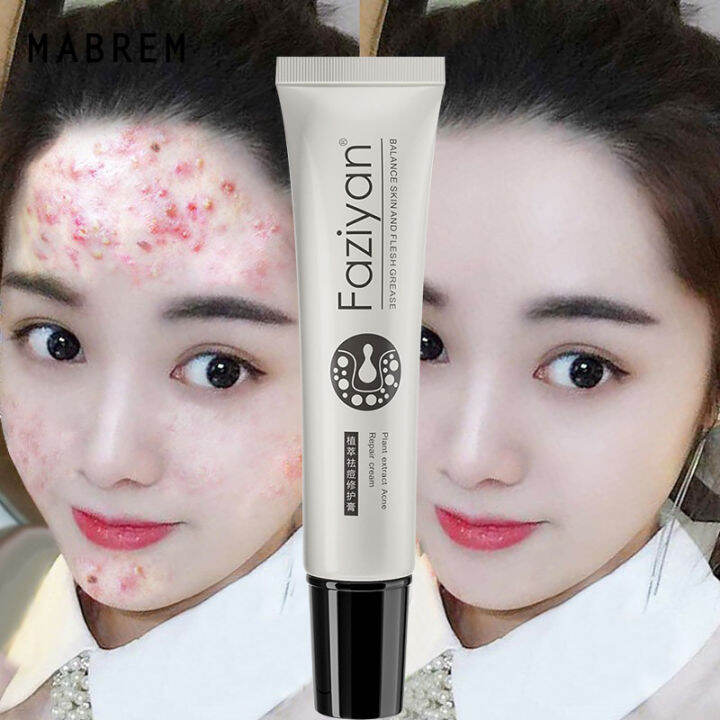 Acne gel cream Acne eraser pimple remover remove pimple marks on face