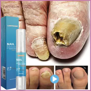 Shop Effective Nail Fungus online - Dec 2023