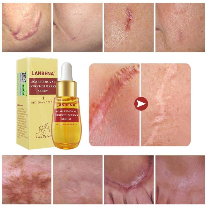 นาฬิกา-lanbena-ขจัดแผลเป็นจากสิวทรีทเม้นเซรั่มรักษาสิว-remover-stretch-marks-anti-สิวลดขนาดรูขุมขนสิวหัวดำครีมบำรุงผิว