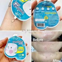 (Good product) Thailands uppoompat Ke Zhihui endorses Mizumi Gentle Formula Anti-Acne Lightening Acne Gel 4g