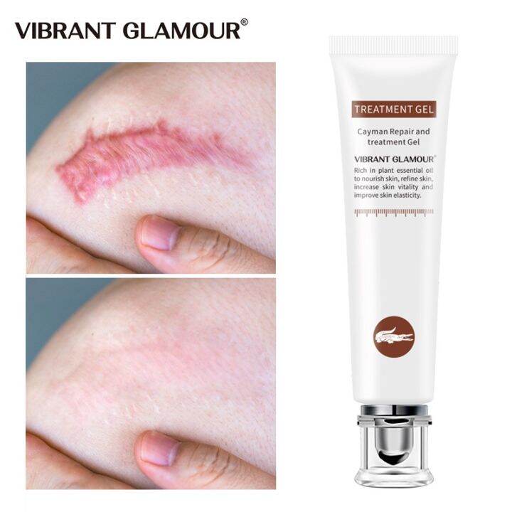 Maternal and Child Health Supplies Scar Remover Acne Cream Scar Cream
