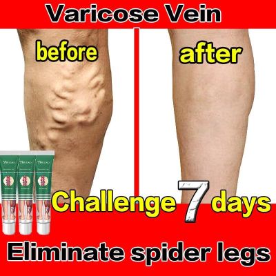 ครีมทรีทเมนท์เส้นเลือดขอดที่เท้าช่วยบรรเทาอาการอักเสบสูตรธรรมชาติ Vasculitis Phlebitis ขาสำหรับเส้นเลือดขอดที่เท้า S
