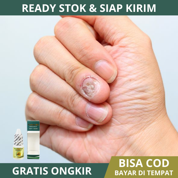 Obat Infeksi Jamur Kuku, Kuku Berjamur, Kuku Rusak, Infeksi Kuku