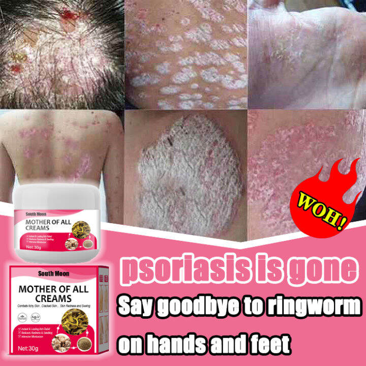 Psoriasis Cream original 30g skin repair psoriasis cream Itchy hands