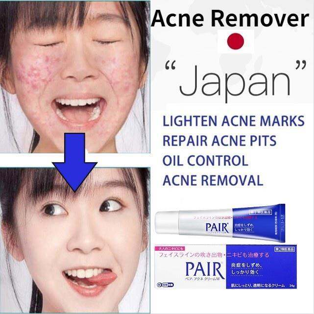 Japan Pair Acne Remover Cream Face Acne Pimple Treatment Skin Repair ...