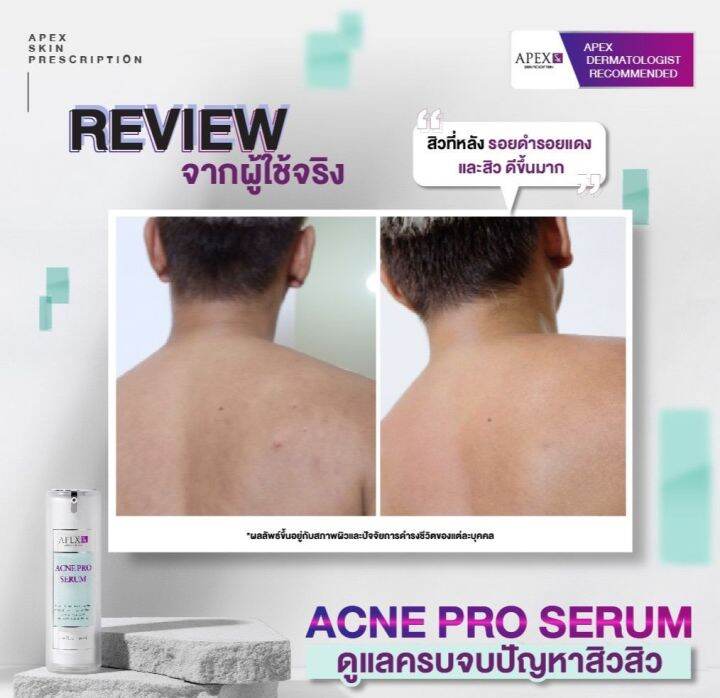 apex-sx-acne-pro-serum-เซรั่มรวมการดูแลปัญหาต่างๆ-ของการเกิดสิวไว้ในขวดเดียว-เหมาะสำหรับคนเป็นสิว-อ่อนโยนมาก-30-ml