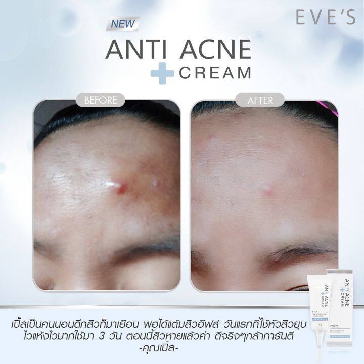 eves-ครีมแต้มสิว-anti-acne-cream-สิวยุบและแห้งไว-ลดอาการอักเสบ-อ่อนโยน-ปลอดภัย