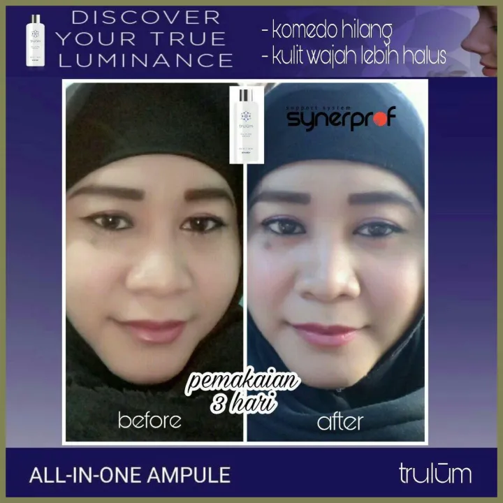 penghilang bopeng bekas jerawat beauty serum trlm 5ml for dry and sensitif skin dan dark spot