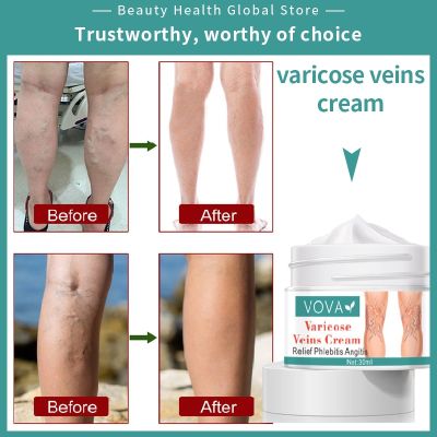 VOVA ครีมเส้นเลือดขอดที่เท้าครีมรักษาที่มีประสิทธิภาพความงาม Vasculitis สมุนไพรจีน Phlebitis ที่ดูแลผิวที่ขา
