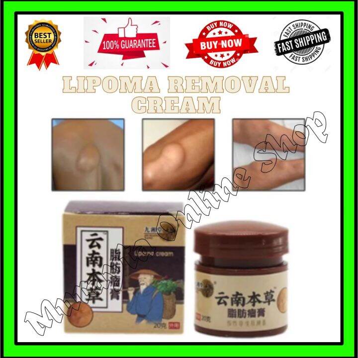 Lipoma | Removal | Herbal Ointment | Tumor Treatment | Multiple Anti ...