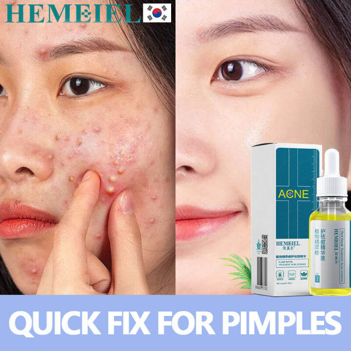 HEMEIEL Tretinoin Cream Original/Pimple Eraser Quick Fx/Anti Acne And