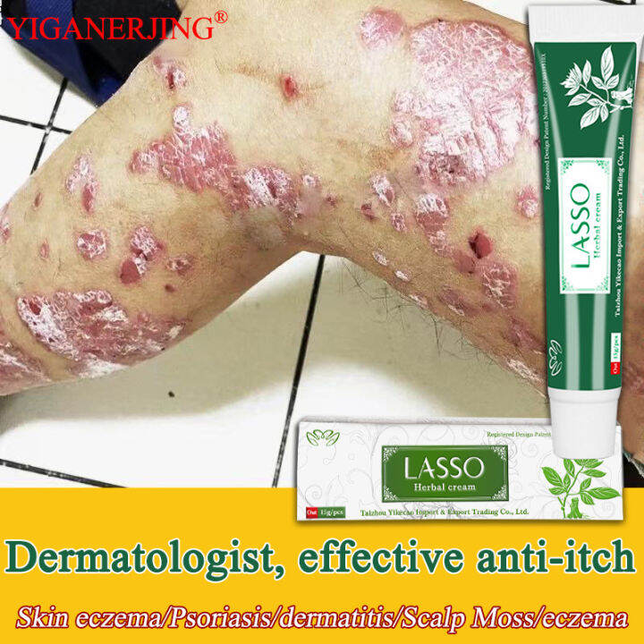 100% effective LASSO psoriasis treatment cream psoriasin deep ...