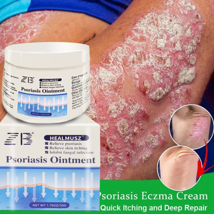 Zb Herbal Antibacterial Cream Psoriasis Eczema Treatment Gamot Sa Buni