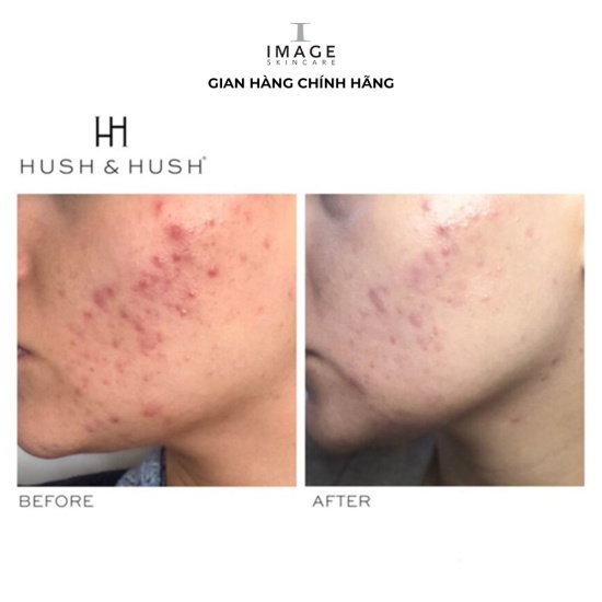Viên uống ngăn ngừa mụn image skincare hush & hush skincapsule clear+ 60 - ảnh sản phẩm 5