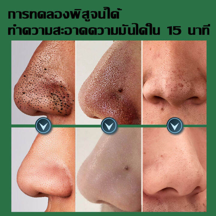 hemeiel-แผ่นลอกสิวเสี้ยน-กำจัดสิวเสี้ยน-ขัดสิวเสี้ยน-นุ่มและขจัดสิวหัวดำ