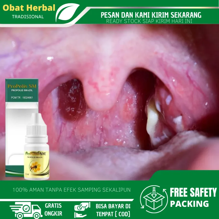 Obat Amandel Alami, Obat Amandel Bengkak, Obat Sakit Radang Tenggorokan ...