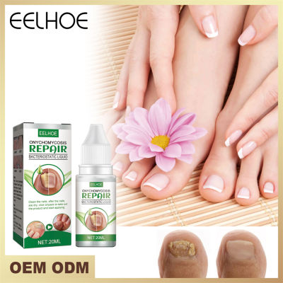 【ON ARRI 20Ml Fungal Nail Repair Essence Serum Nails Fungus Foot Toe Fungal Removal Gel Anti Infection Paronychia Onychomycosis Repair