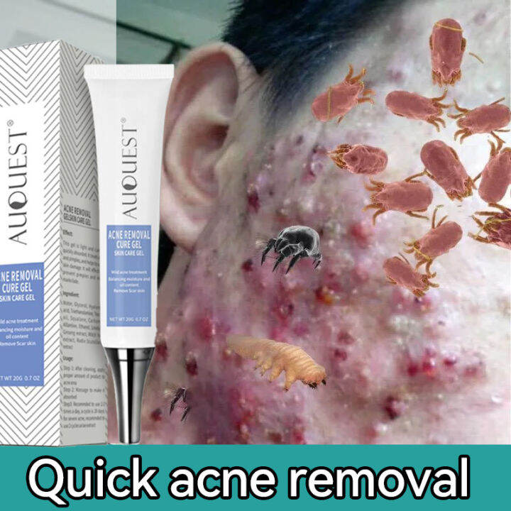 Acne Scars Remover for Face Pimples Acne Remover Best Seller Scar Gel