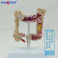 Spot parcel post Simulation Human Colon Anatomy Model Anorectal Intestinal Gastrointestinal Digestive System Teaching