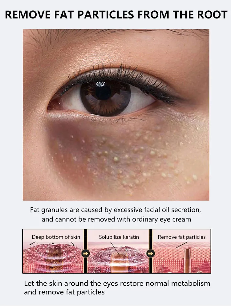 Vivirich 【Flash Sale】Fat Granule Removal Essence Fat Granule Antibacterial  Liquid Eye Serum Cream | Lazada PH