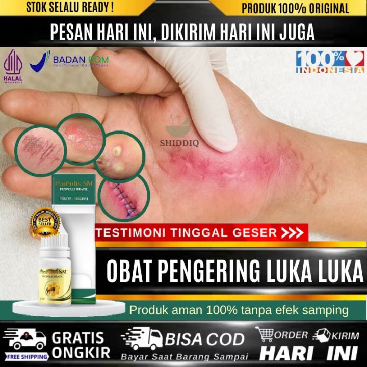 Obat Luka Infeksi Yang Lama Sembuh Mengobati Luka Jatuh Dari Motor