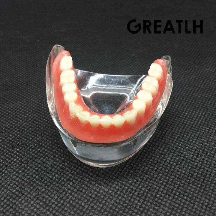 dental-overdenture-interior-mandibular-lower-teeth-model-mandibular-with-implant-restoration-tooth-dental-teaching-study