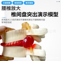 Authentic medical human lumbar intervertebral disc model is prominent pathological presentation spinal vertebrae joint standard model