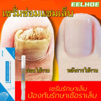 EELHOE ซ่อมเล็บ เซรั่มซ่อมแซมเล็บ ซ่อมแซมเล็บเสีย กำจัดเล็บเสีย ส่งเสริมการเจริญเติบโตของเล็บดีเยี่ยม ยากันเชื่อราเล็บ（ครีมบำรุงเล็บ ยาแก้เชื้อราที่เล็บ น้ำยาต้านเชื้อรา เซรั่มเล็บขบ ยาใส่เล็บเป็นเชื้อรา น้ำยาบำรุงเล็บ เชื้อราเล็บมือ）