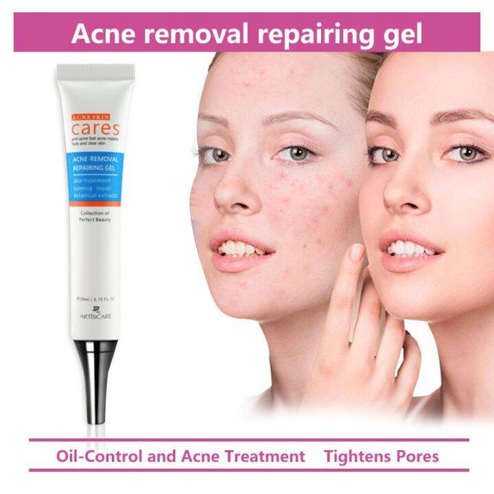 Freckle Cream Extract Acne Removal Scars Marks Treatment Facial Acne