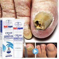 ครีมรักษาเชื้อราที่เล็บที่มีประสิทธิภาพ Foot Toe NAIL fungus removal Serum Anti-infection paronychia Onychomycosis rep.diamond MINE