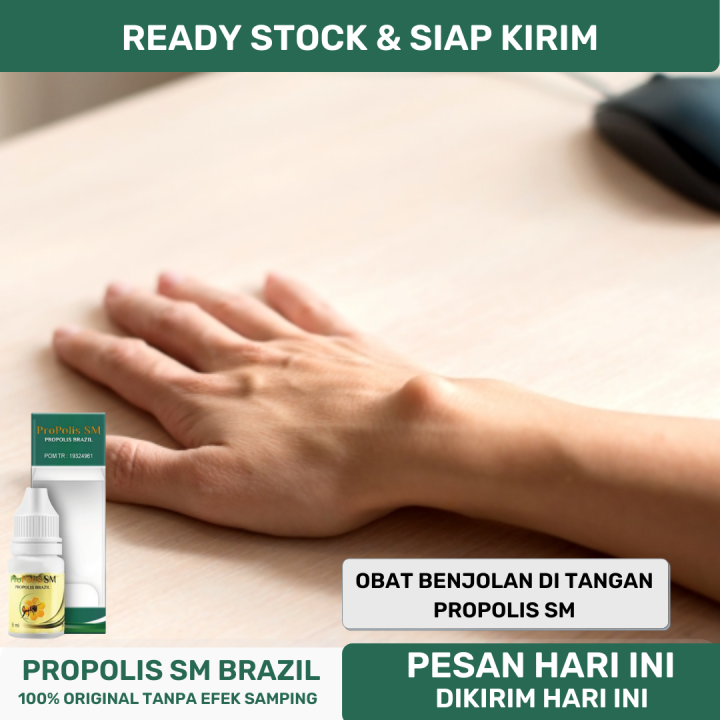 Obat Penghancur Benjolan Ganglion, Benjolan Di Pergelangan Tangan ...