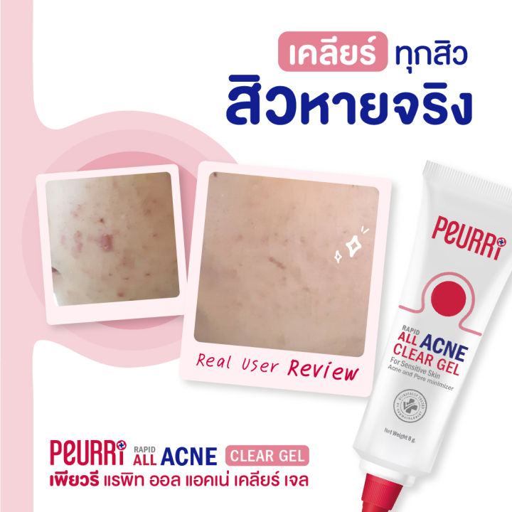 เจลแต้มสิว-peurri-all-acne-clear-gel-เพียวรี-แรพิท-ออล-แอคเน่-เคลียร์-เจล-3-หลอด