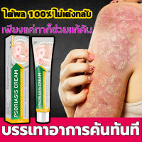 ครีมทาแก้เชื้อรา ครีมแก้คัน ยาทาคันเชื้อรา 20g(สารสกัดจากพืชใช้ได้ทั้งตัวบอกลาผิวคันได้ง่ายๆ）สะเก็ดเงิน กลาก ครีมลดอาการคัน ยาทาแก้คัน ผิวหนัง เห็นผลใน 7 วัน#Bangkokจัดส่งในวันเดียวกัน#