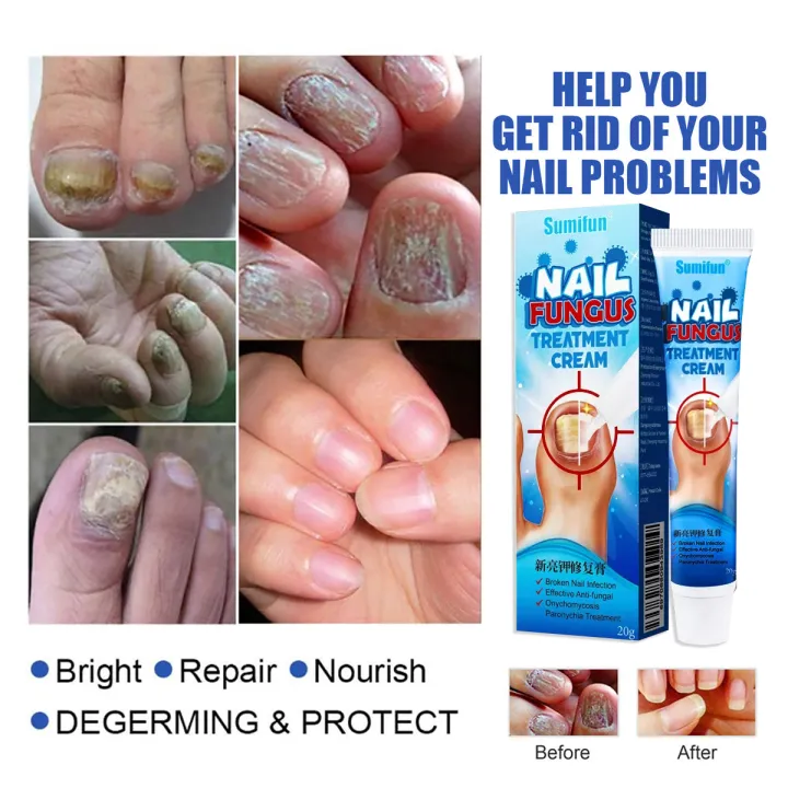Nail Fungus Treatment Nail Repair Treatment Repair Cream Nail Fungus