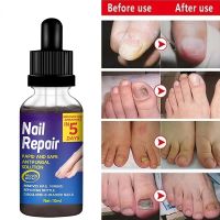 【CW】 New Powerful Fungicidal Nail Fungus Repair Damaged Skin Essential Oils Essence Anti fungal Fungal Care Massage Oil