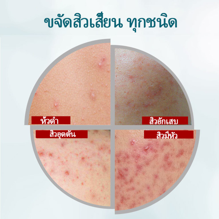 hemeiel-ครีมกำจัดสิวเสี่ยน-ทุกประเภท-สำหรับสิวอักเสบ-ลดสิว-รอยสิว-สามารถลดสิว