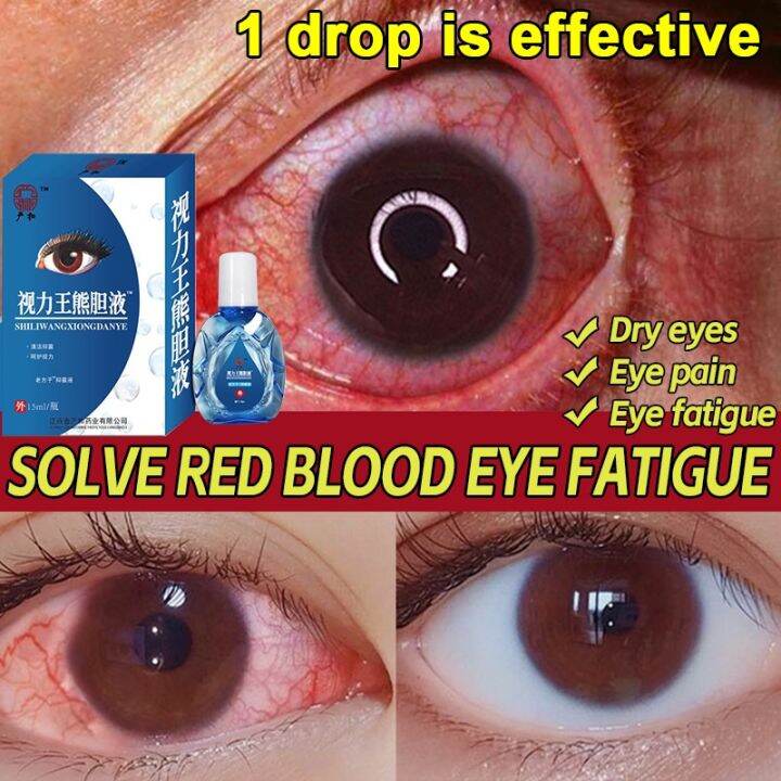 Eye Drops Artificial Tears Eyedrop Treat Bloodshot Eye Cataract Relieve
