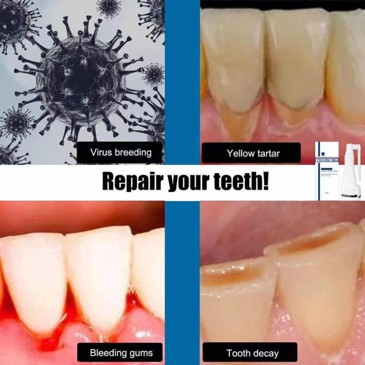 ยาสีฟันฟันขาว-ยาสีฟันขจัดหิน-ยาสีฟันฟอกขาว-ยาสีฟัน-ทำความสะอาดช่องปากขจัดกลิ่นปากขจัดคราบจุลินทรีย์และสิ่งสกปรกที่ฝังแน่น-dental-calculus