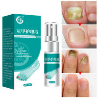 Nail Fungal Treatment Feet Care Essence Nail Foot Whitening Toe Nail Fungus Removal Gel Anti Infection Paronychia Onychomycosis