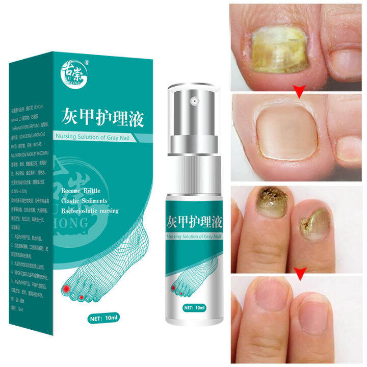 Nail Fungal Treatment Feet Care Essence Nail Foot Whitening Toe Nail