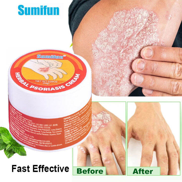 Sumifun Psoriasis Cream Psoriasis Eczema Cream Herbal Antibacterial ...