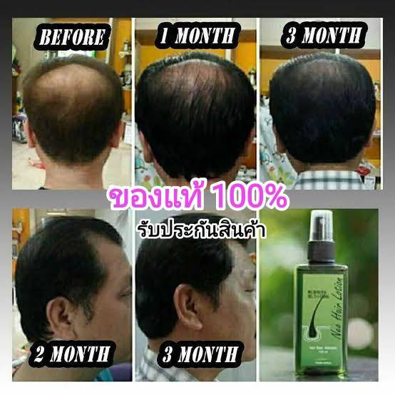 โปรโมชั่น-2-แถม-1-neo-hair-lotion-แถมฟรี-roller-ส่งด่วนทุกวัน-ของแท้-100-นีโอแฮร์โลชั่น-neohair-ส่งตรงจากโรงงาน