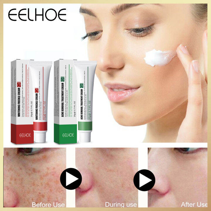 Eelhoe Acne Removingandspeckle Removing Cream Herbal Acne Removal Face Cream Oil Control Anti Acne