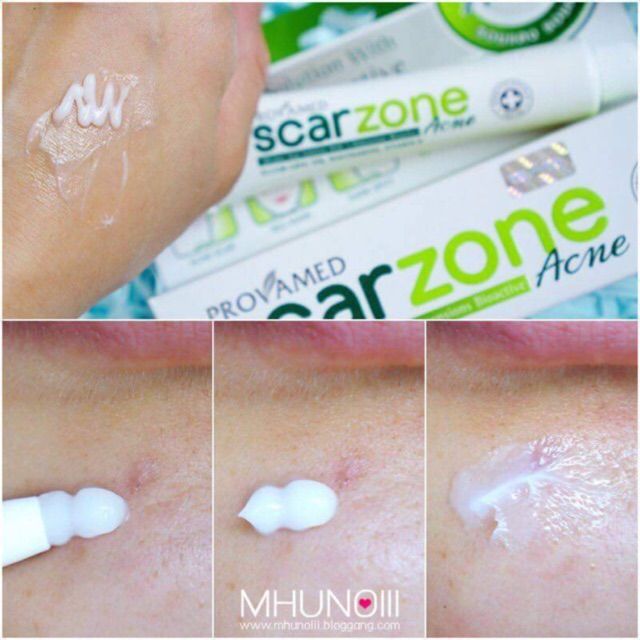 ล้างสต้อค-รอยสิวจาง-provamed-scarzone-acne-รอยแผลจากสิว-หลุมสิว-รอยแดง-รอยดำ-จากสิว