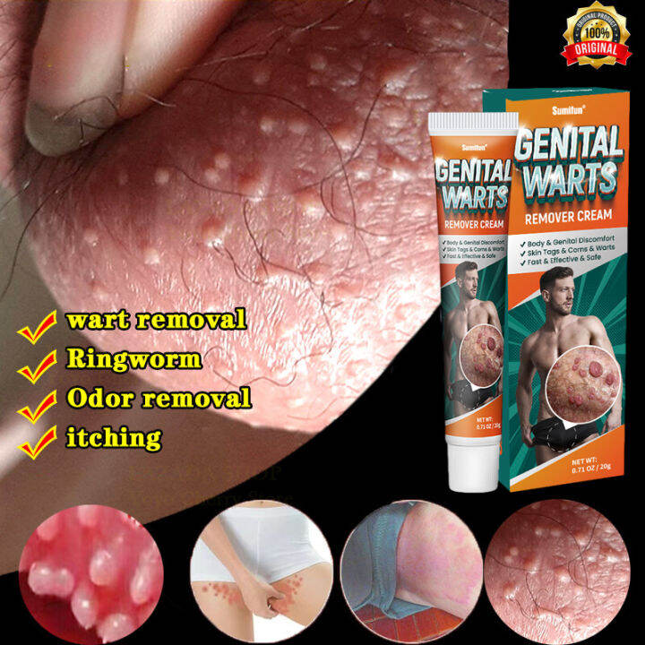 Effective Genital Wart Remover Cream 20g RemoverAntibacterial Cream Acne Treatment Neck Skin