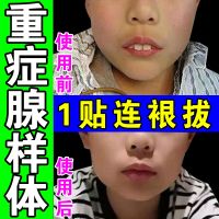 [One sticker] Adenoid hypertrophy face corrector for childrens snoring stuffy nose protruding mouth Chinese nose sticker