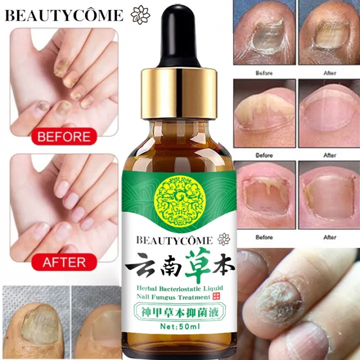 Nail Repair Essence Serum Fungal Nail Treatment Remove
