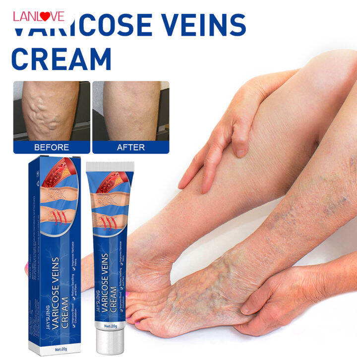 LANLOVE Varicose Veins Cream Vasculitis Relief Phlebitis Angiitis ...