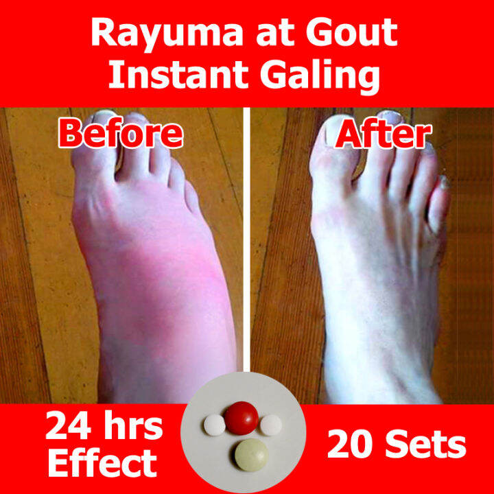 NOTIKU 20 Sets Arthritis Rayuma Gout Relief, Arthritis Medicine